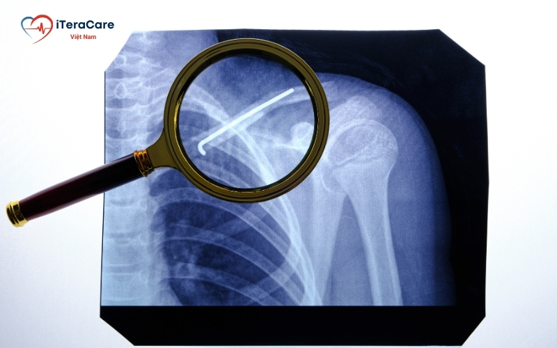 gãy xương quai xanh có ảnh hưởng đến tính mạng