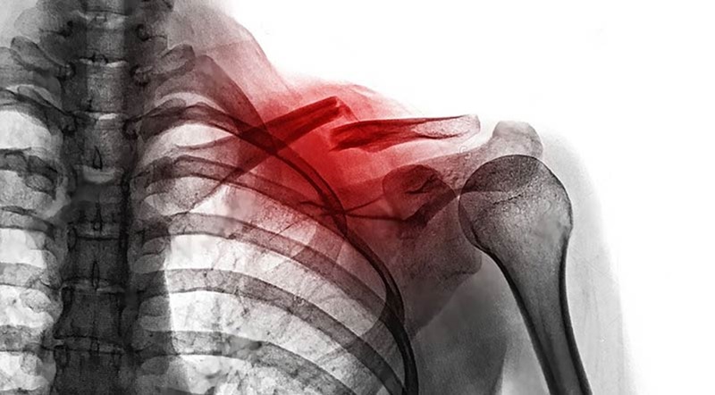 gãy xương quai xanh nguyên nhân do đâu