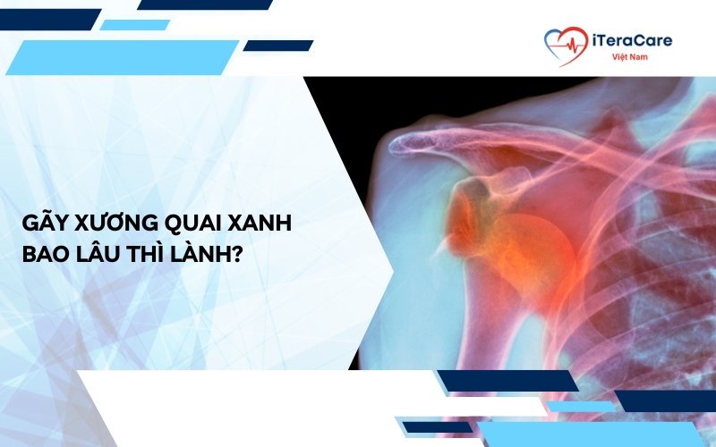 gãy xương quai xanh