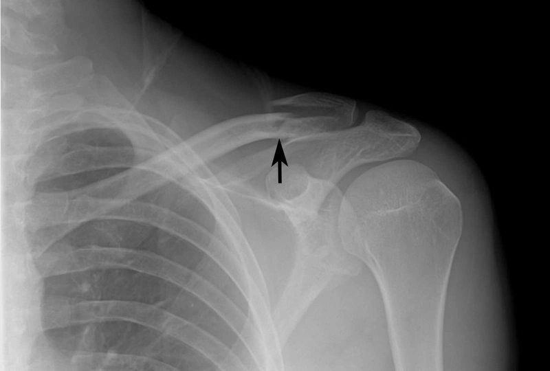 quá trình hồi phục xương đòn