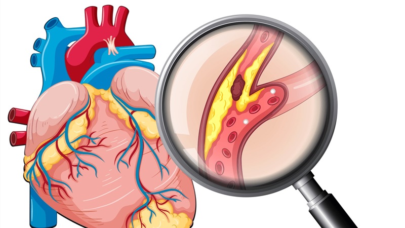 chuẩn đoán bệnh tim mạch