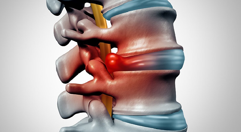 tác dụng điều trị thoát vị đĩa đệm