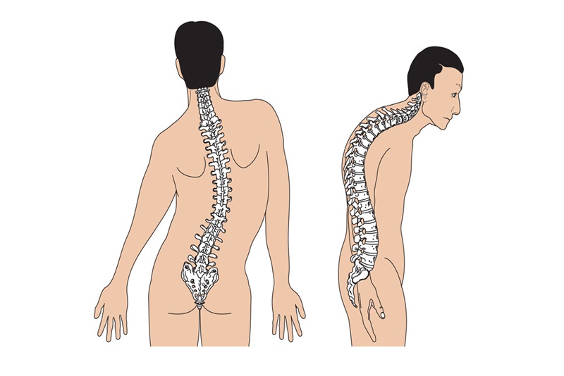 ngừa tiến triển cong vẹo cột sống