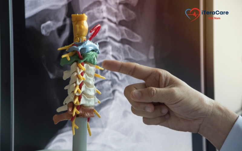 viêm cột sống dính khớp là gì